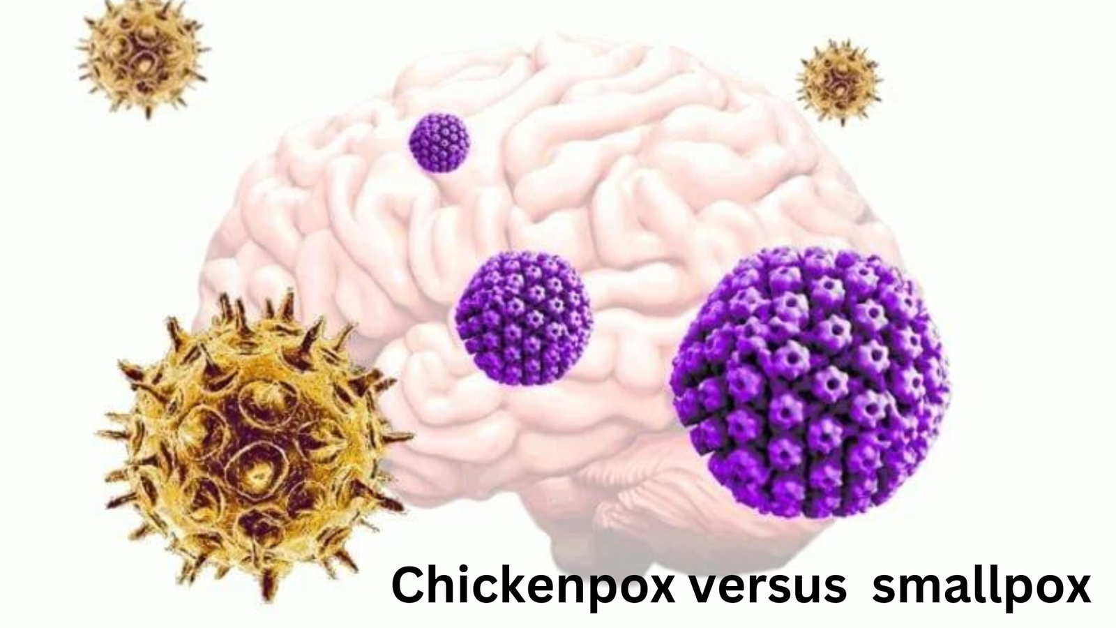 Chickenpox versus smallpox