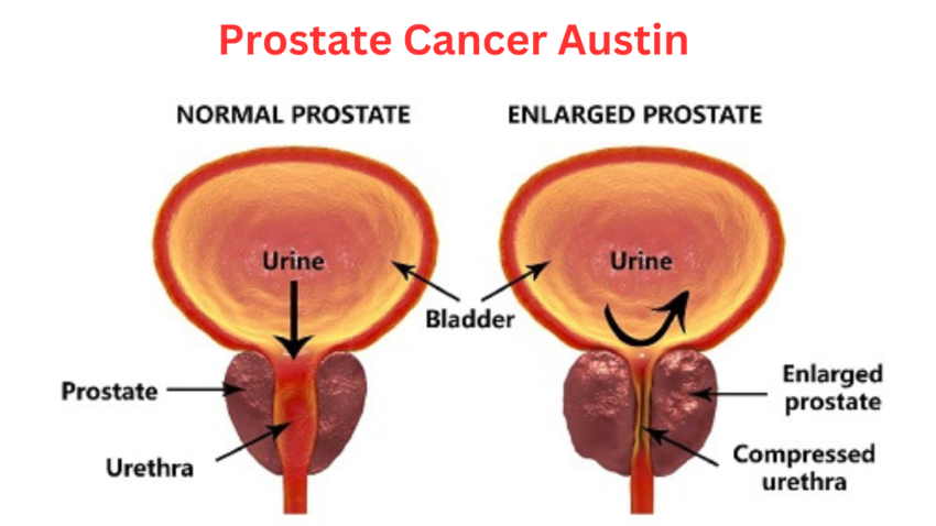 Prostate Cancer Austin