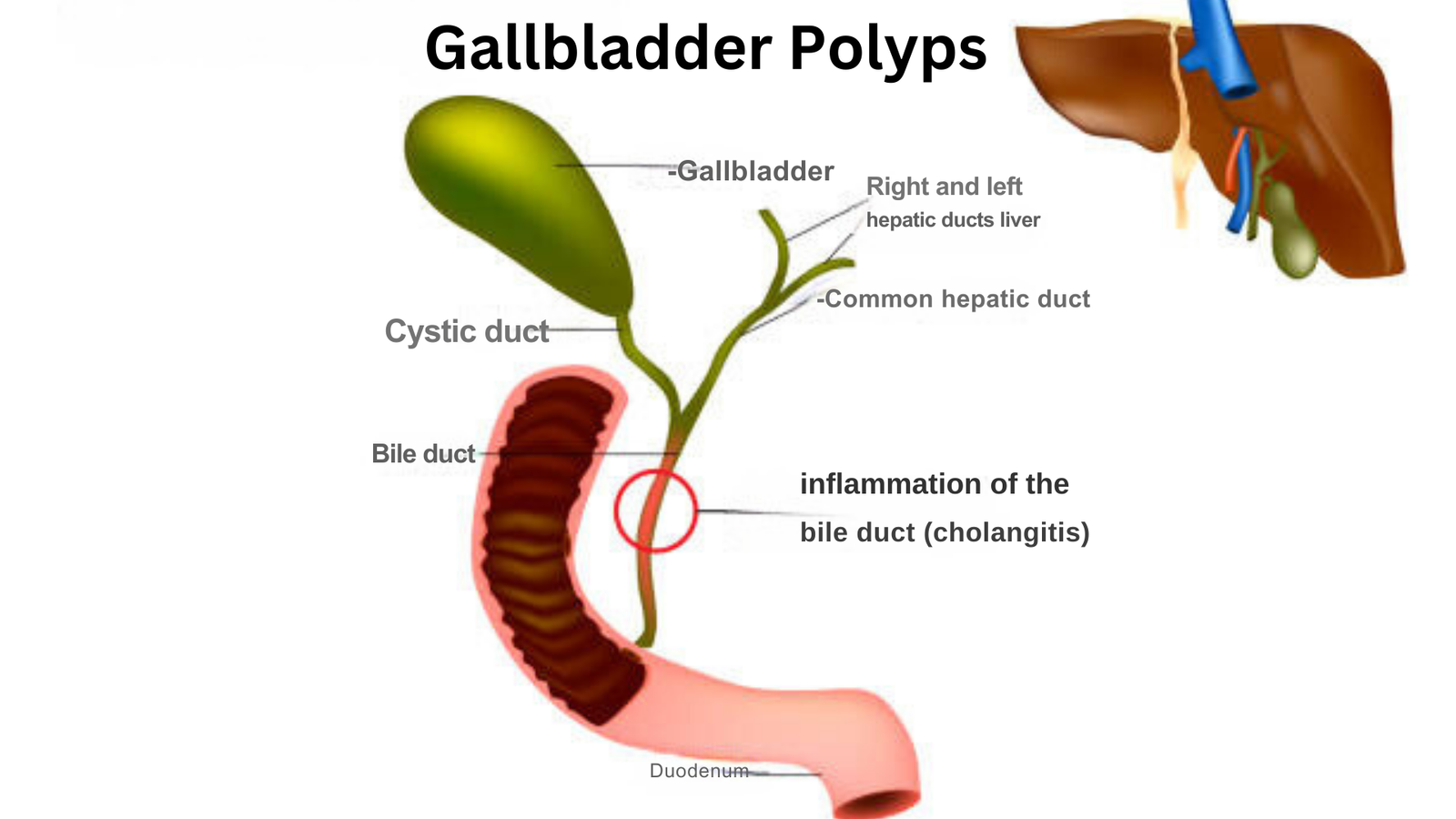 Gallbladder Polyps ICD 10