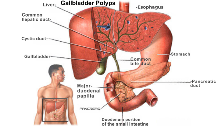 Gallbladder Polyps ICD 10