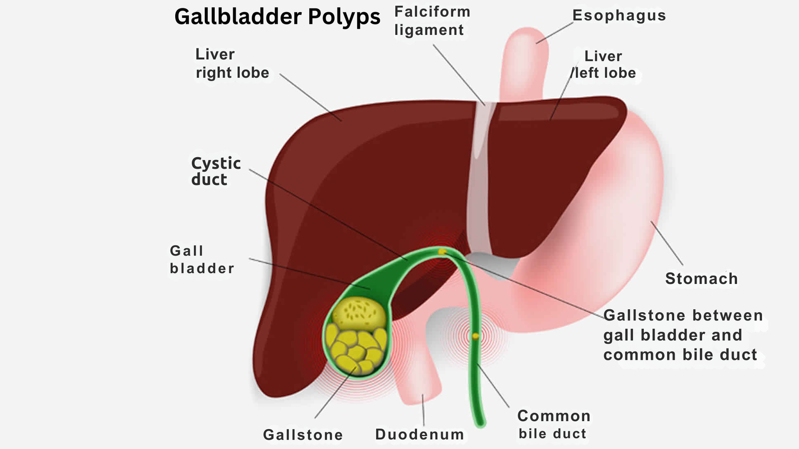 Gallbladder Polyps ICD 10