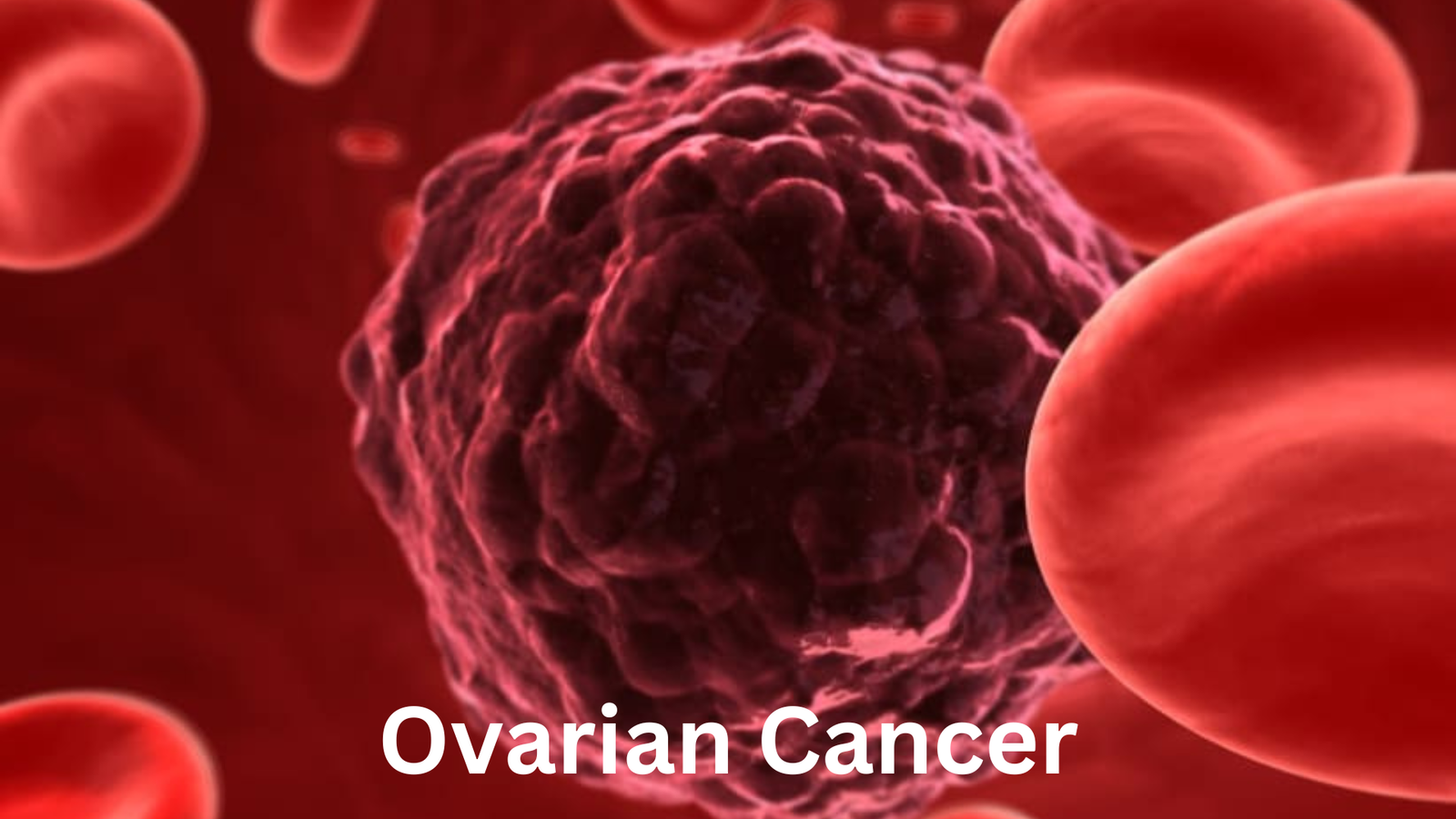 Ovarian cancer