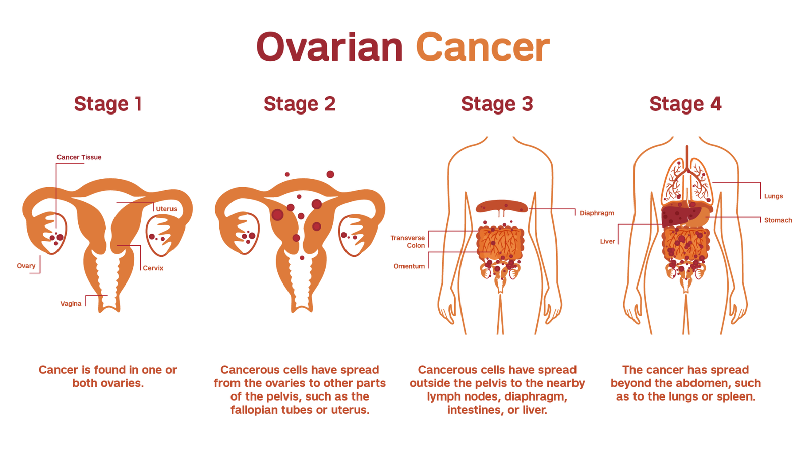 Ovarian Cancer 