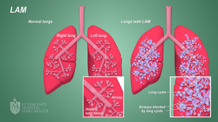 Lam Lung Disease